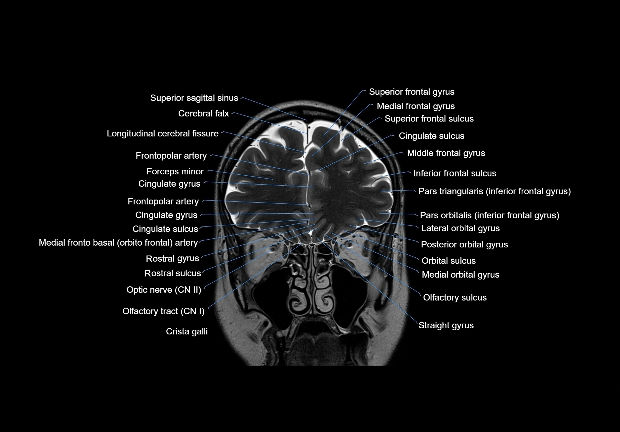 MRI Brain coronal cross sectional labelled anatomy 3T image  -img-00001-00018.webp